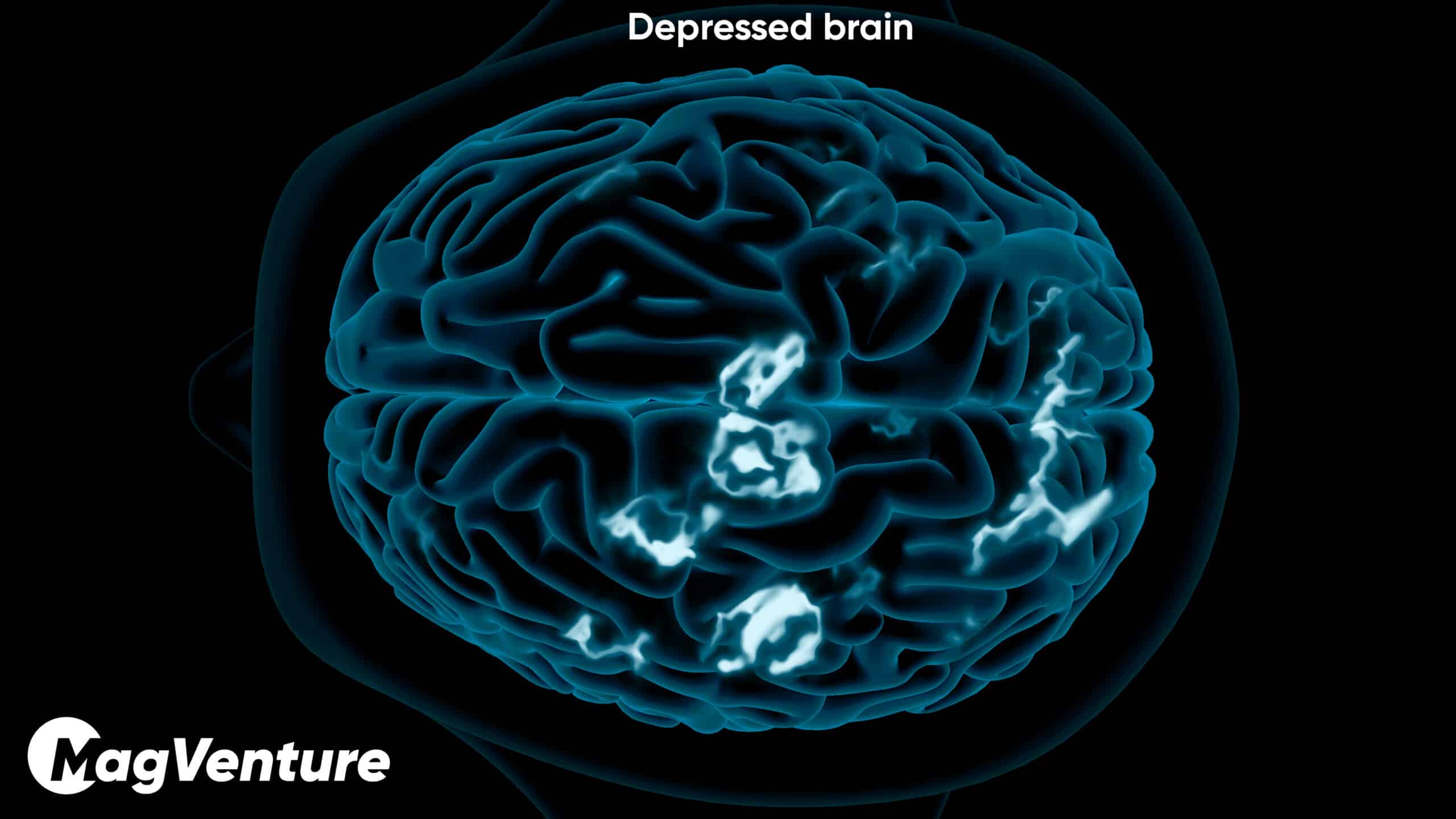 Brain scan showing reduced activity in a brain affected by depression