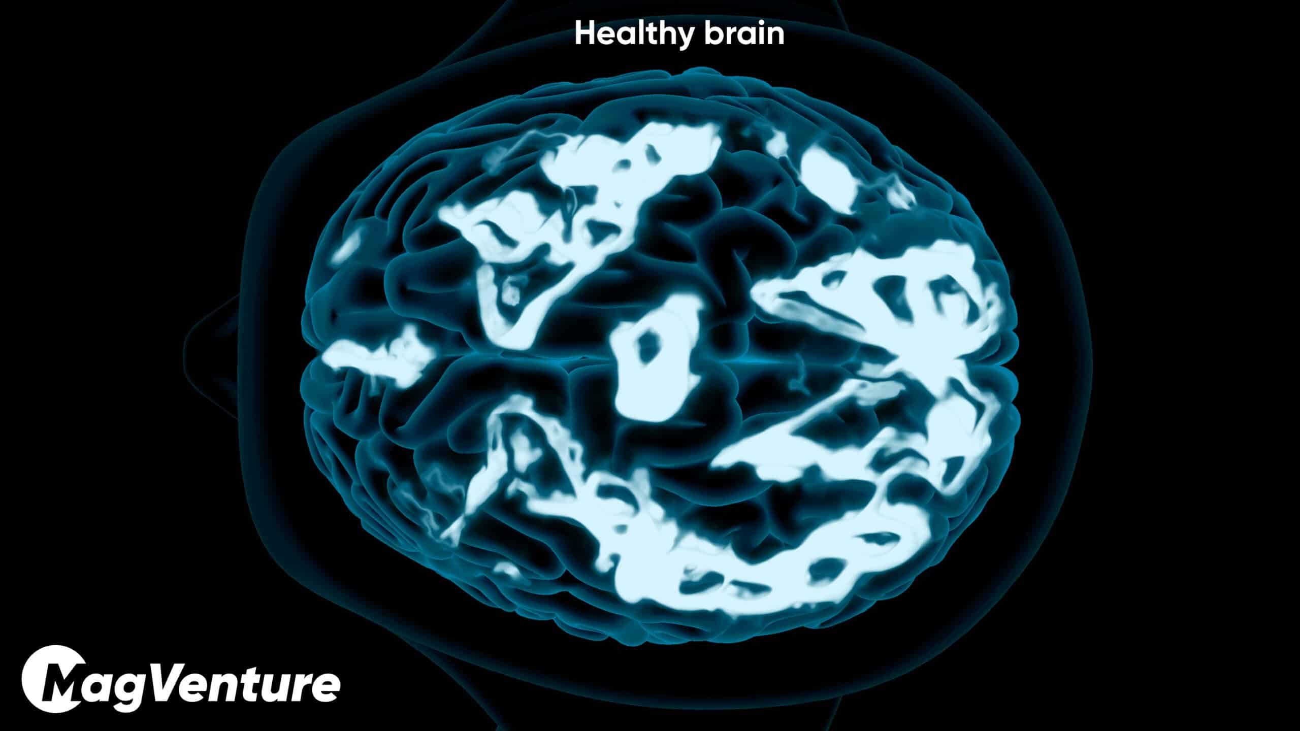 Brain scan showing healthy activity levels